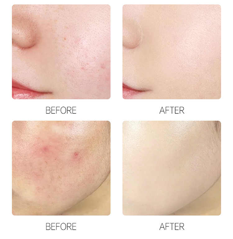 Пластырь от прыщей